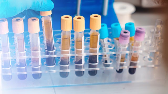 O Que é a Imunohistoquímica no Câncer de Mama?